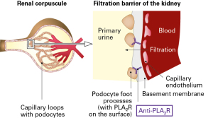 Binding of anti-PLA2R autoantibodies to podocytes impairs filtration function of kidney