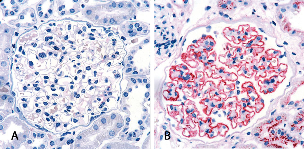 Histologische Untersuchung einer renalen Gewebeprobe (A) einer gesunden Person und (B) eines MN Patienten. Bei der MN lagern sich Immunkomplexe entlang der glomulären Basalmembran ab, die über eine Antikörperfärbung nachgewiesen werden können (rot).