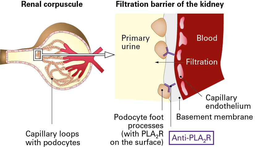 Binding of anti-PLA2R autoantibodies to podocytes impairs filtration functi...